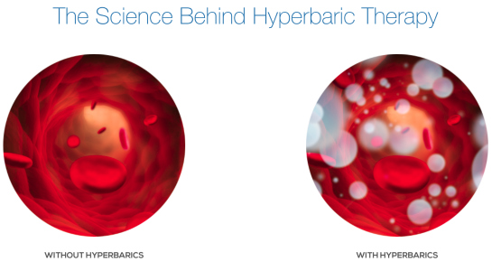 what-is-hyperbaric-oxygen-treatment hyperbaric oxygen therapy treatments